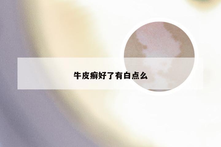 牛皮癣好了有白点么
