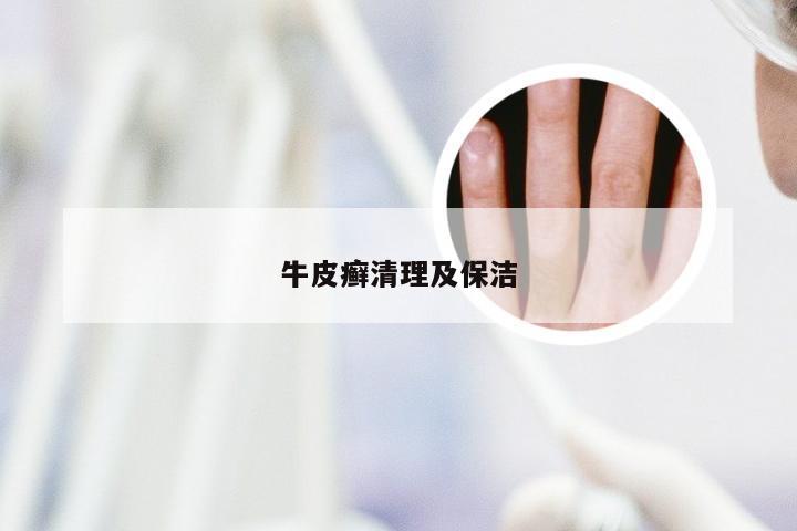 牛皮癣清理及保洁