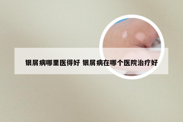 银屑病哪里医得好 银屑病在哪个医院治疗好
