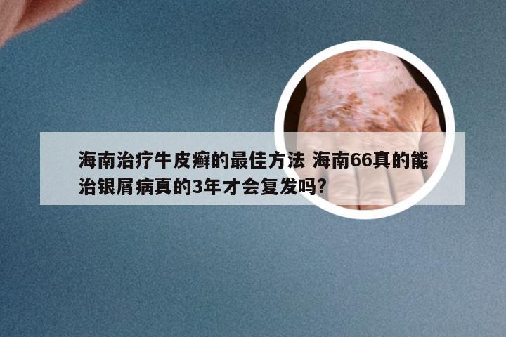 海南治疗牛皮癣的最佳方法 海南66真的能治银屑病真的3年才会复发吗?
