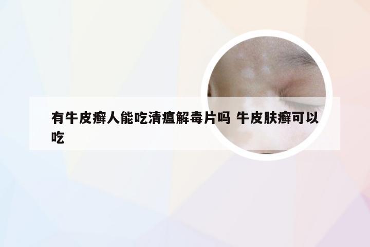 有牛皮癣人能吃清瘟解毒片吗 牛皮肤癣可以吃