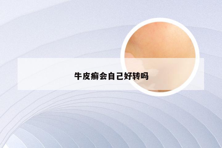 牛皮癣会自己好转吗