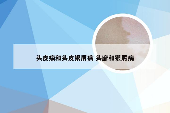 头皮痫和头皮银屑病 头廨和银屑病