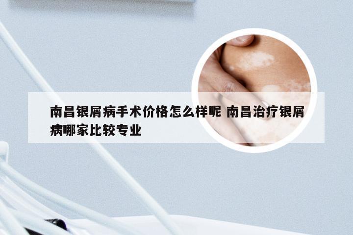南昌银屑病手术价格怎么样呢 南昌治疗银屑病哪家比较专业