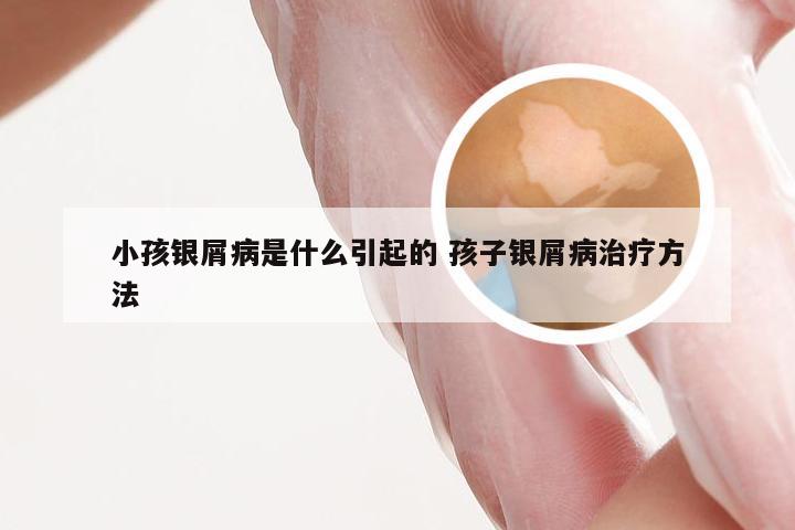 小孩银屑病是什么引起的 孩子银屑病治疗方法