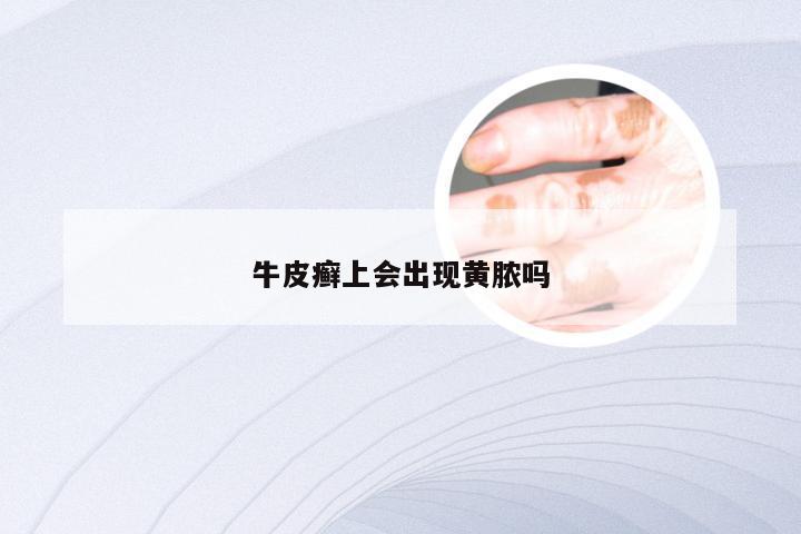 牛皮癣上会出现黄脓吗