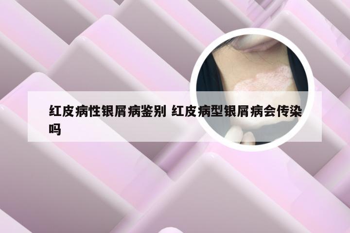 红皮病性银屑病鉴别 红皮病型银屑病会传染吗