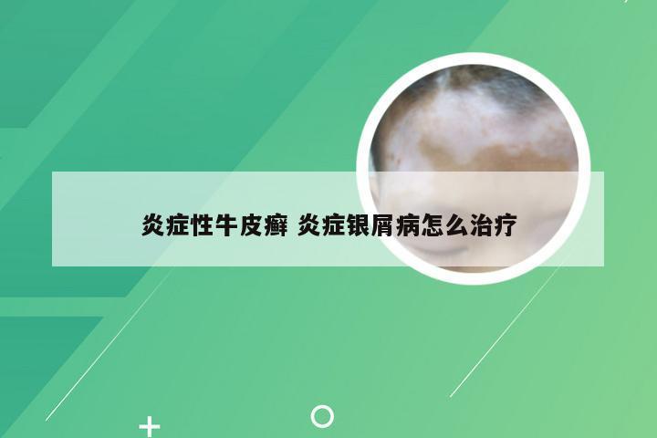 炎症性牛皮癣 炎症银屑病怎么治疗