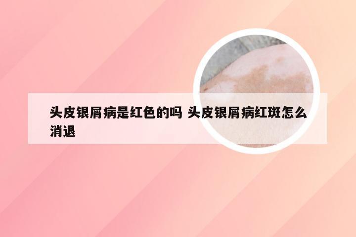 头皮银屑病是红色的吗 头皮银屑病红斑怎么消退