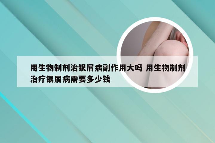 用生物制剂治银屑病副作用大吗 用生物制剂治疗银屑病需要多少钱