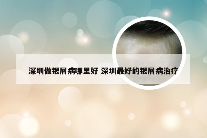 深圳做银屑病哪里好 深圳最好的银屑病治疗