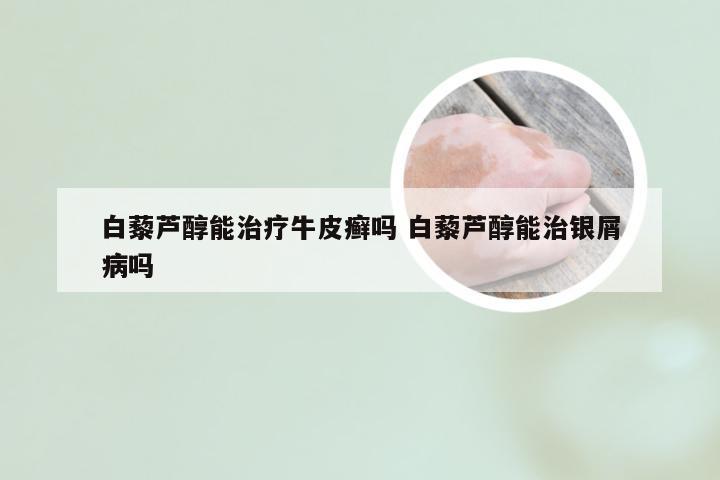 白藜芦醇能治疗牛皮癣吗 白藜芦醇能治银屑病吗