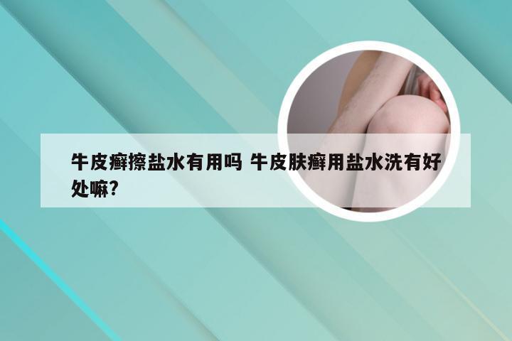 牛皮癣擦盐水有用吗 牛皮肤癣用盐水洗有好处嘛?