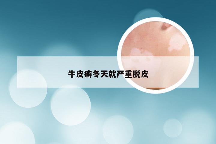 牛皮癣冬天就严重脱皮