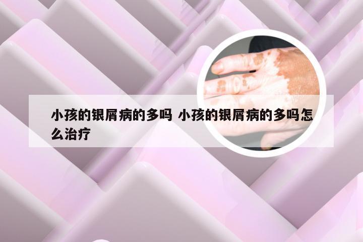 小孩的银屑病的多吗 小孩的银屑病的多吗怎么治疗