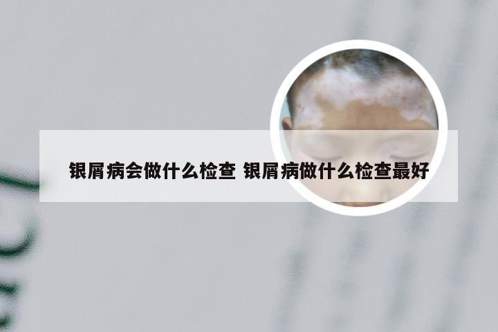 银屑病会做什么检查 银屑病做什么检查最好