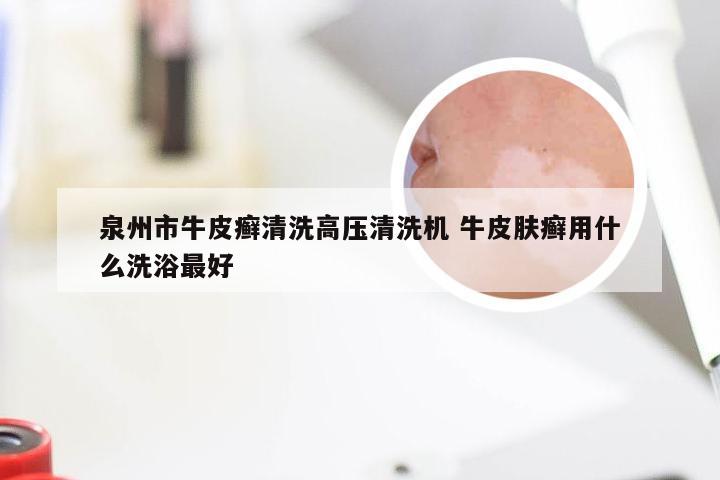 泉州市牛皮癣清洗高压清洗机 牛皮肤癣用什么洗浴最好
