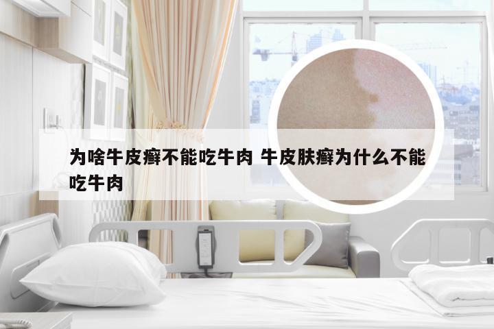 为啥牛皮癣不能吃牛肉 牛皮肤癣为什么不能吃牛肉