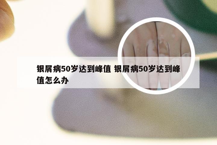 银屑病50岁达到峰值 银屑病50岁达到峰值怎么办