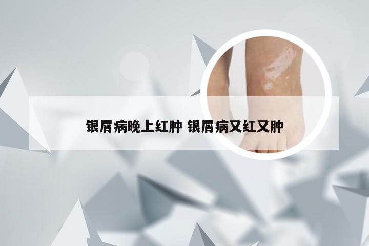 银屑病晚上红肿 银屑病又红又肿