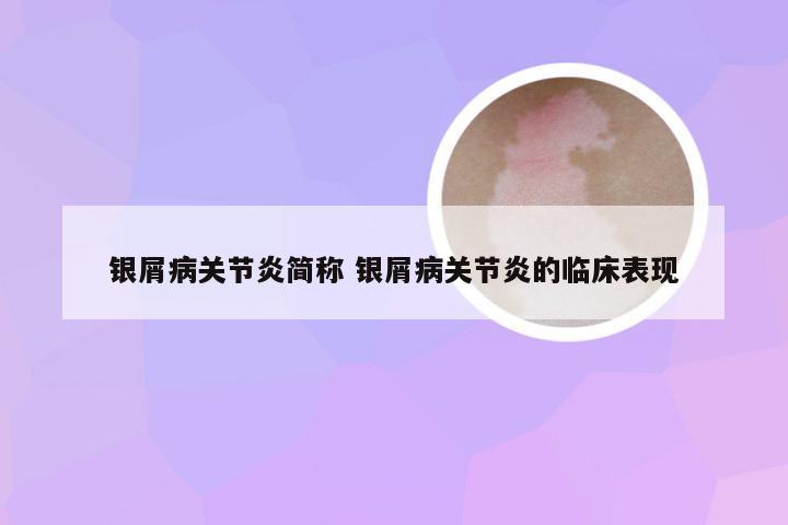 银屑病关节炎简称 银屑病关节炎的临床表现