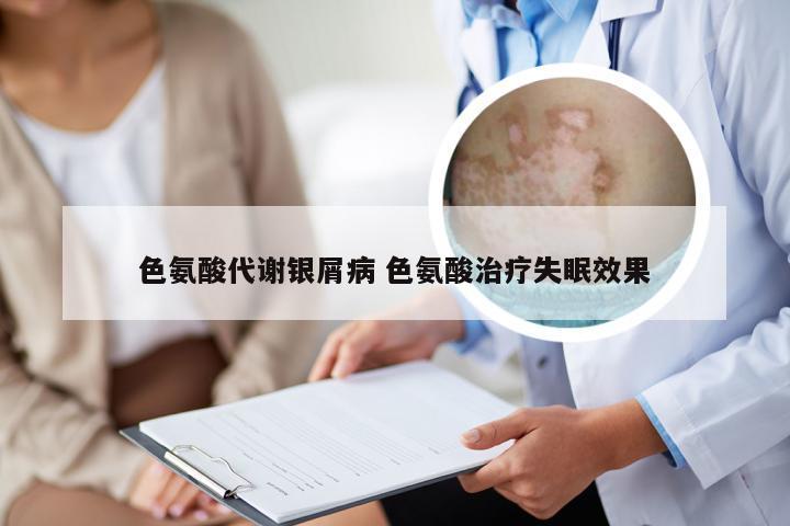 色氨酸代谢银屑病 色氨酸治疗失眠效果