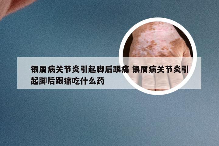 银屑病关节炎引起脚后跟痛 银屑病关节炎引起脚后跟痛吃什么药