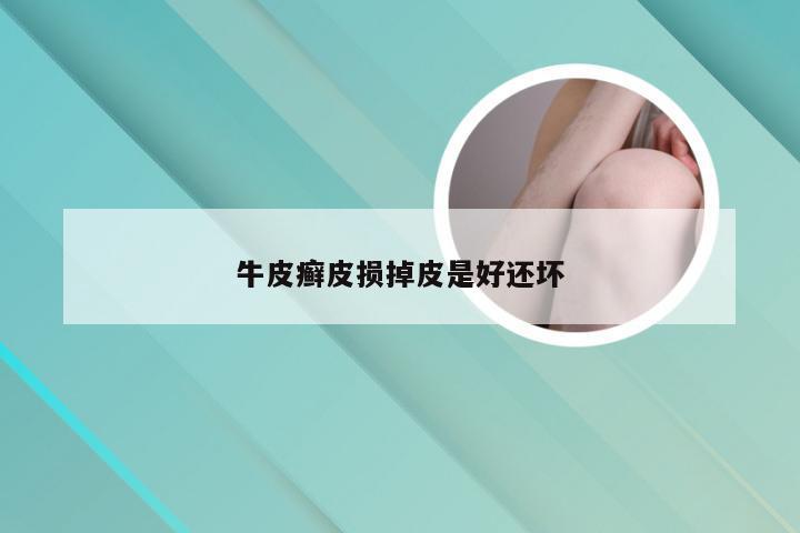 牛皮癣皮损掉皮是好还坏