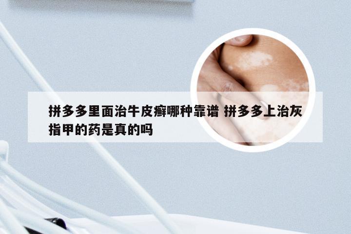 拼多多里面治牛皮癣哪种靠谱 拼多多上治灰指甲的药是真的吗