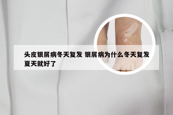 头皮银屑病冬天复发 银屑病为什么冬天复发夏天就好了