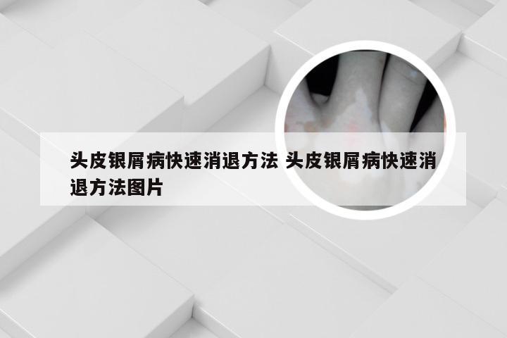 头皮银屑病快速消退方法 头皮银屑病快速消退方法图片