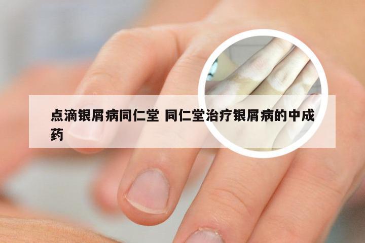 点滴银屑病同仁堂 同仁堂治疗银屑病的中成药
