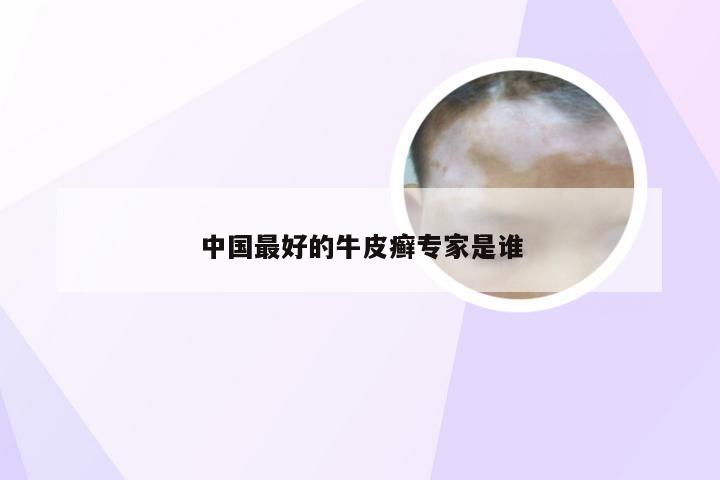 中国最好的牛皮癣专家是谁