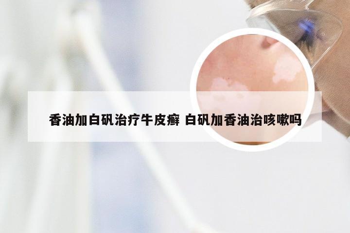 香油加白矾治疗牛皮癣 白矾加香油治咳嗽吗