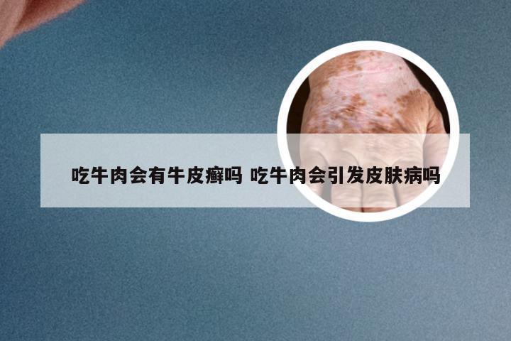 吃牛肉会有牛皮癣吗 吃牛肉会引发皮肤病吗