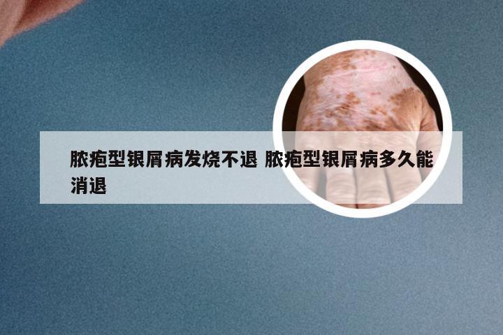 脓疱型银屑病发烧不退 脓疱型银屑病多久能消退