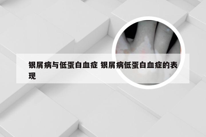 银屑病与低蛋白血症 银屑病低蛋白血症的表现