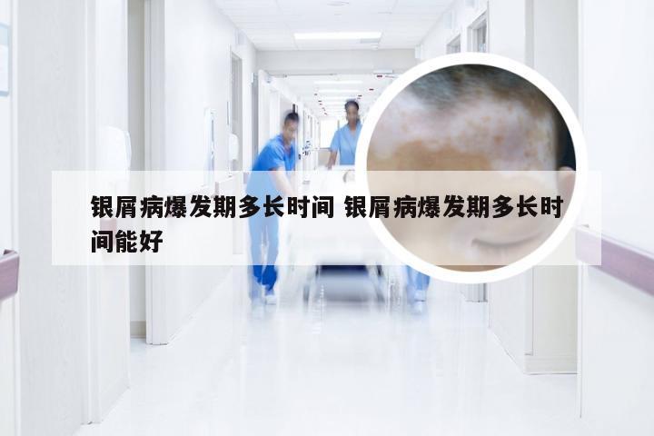 银屑病爆发期多长时间 银屑病爆发期多长时间能好