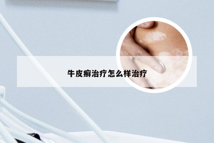 牛皮癣治疗怎么样治疗
