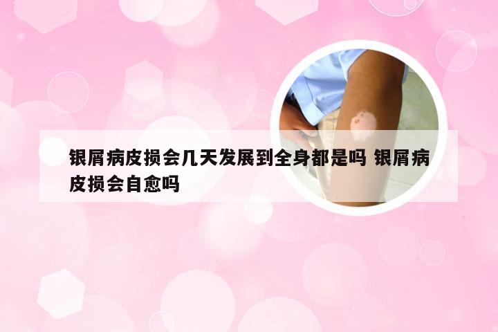 银屑病皮损会几天发展到全身都是吗 银屑病皮损会自愈吗