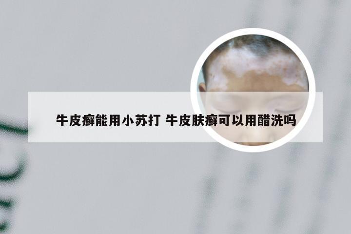 牛皮癣能用小苏打 牛皮肤癣可以用醋洗吗