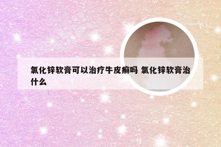 氯化锌软膏可以治疗牛皮癣吗 氯化锌软膏治什么