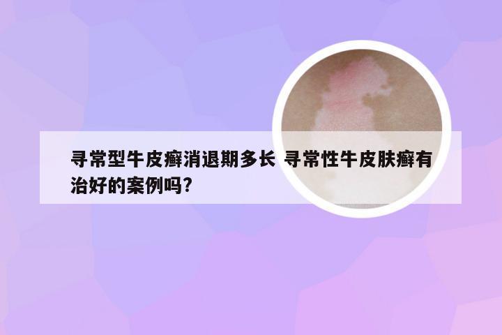 寻常型牛皮癣消退期多长 寻常性牛皮肤癣有治好的案例吗?