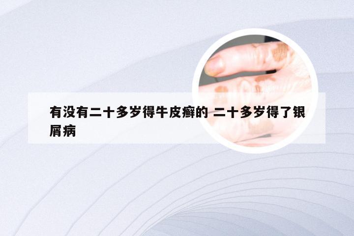 有没有二十多岁得牛皮癣的 二十多岁得了银屑病