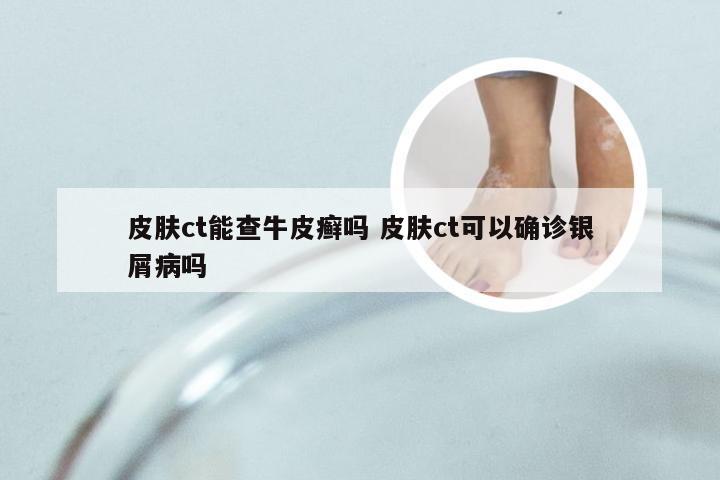 皮肤ct能查牛皮癣吗 皮肤ct可以确诊银屑病吗