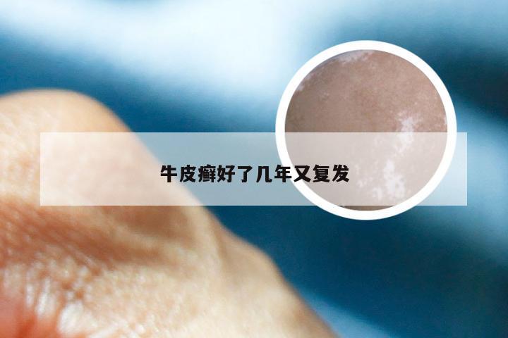 牛皮癣好了几年又复发