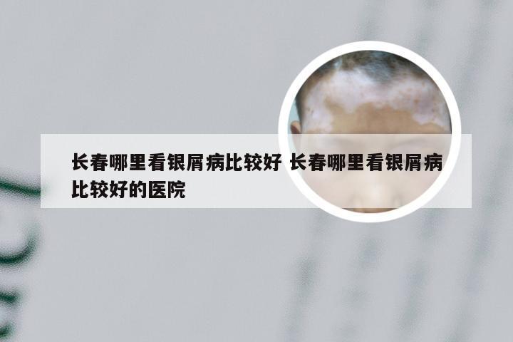长春哪里看银屑病比较好 长春哪里看银屑病比较好的医院