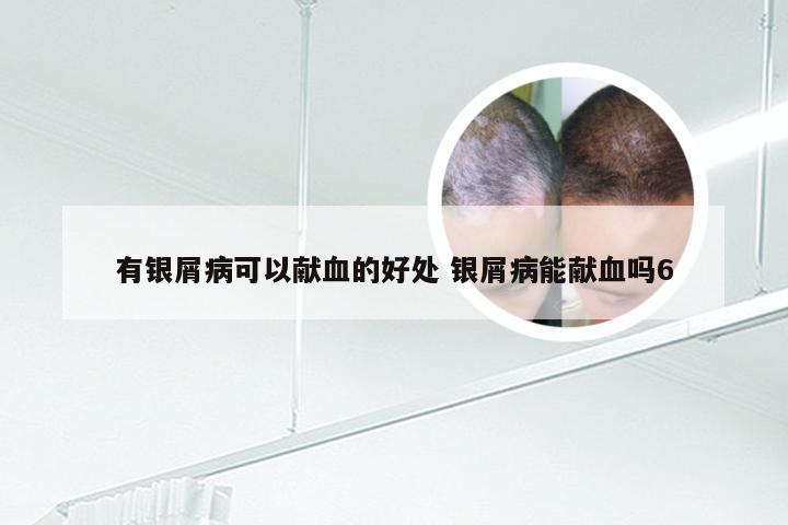 有银屑病可以献血的好处 银屑病能献血吗6