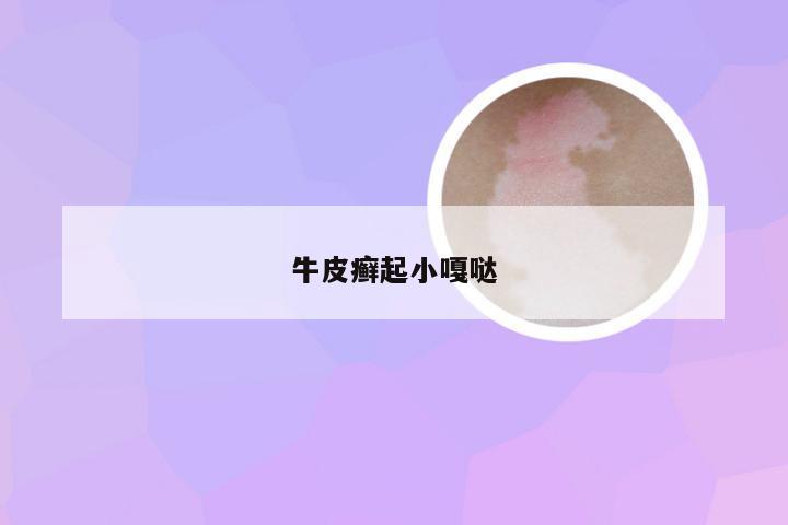 牛皮癣起小嘎哒