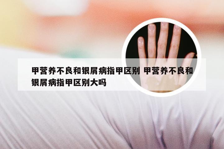 甲营养不良和银屑病指甲区别 甲营养不良和银屑病指甲区别大吗